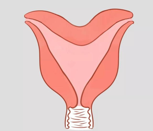 子宮畸形的三種情況:縱膈子宮,雙角子宮和雙子宮__鳳凰網