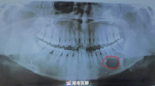 女子多长了一颗牙就医时已生出囊肿多生牙为何生出囊肿