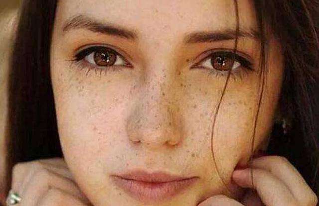 黄褐斑是女人肾虚的表现