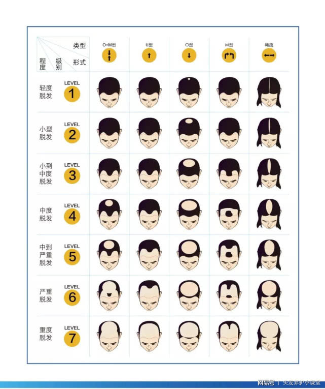 七级脱发 这是男性脱发的严重形式,表现为除马蹄形脱发外,耳周和枕部