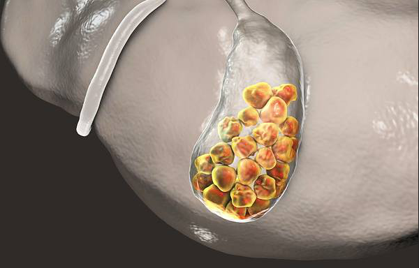 膽結石會誘發胰腺炎嗎告知你膽結石的幾個真相