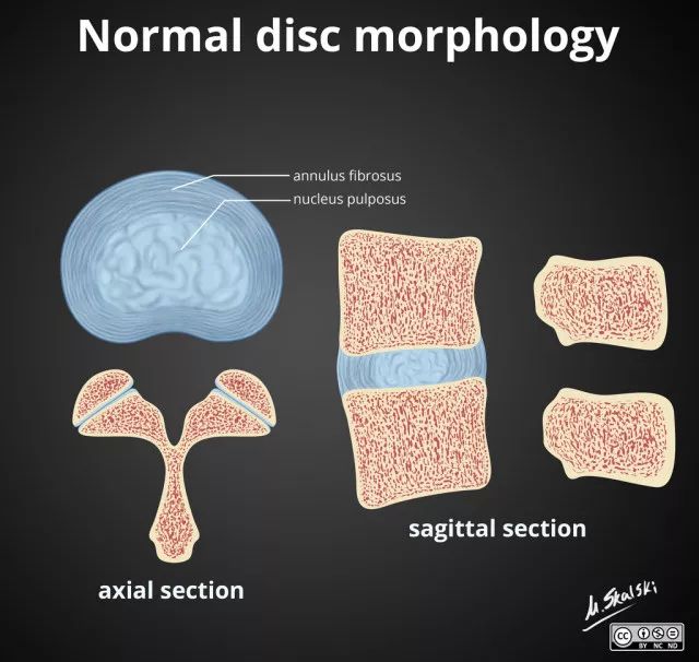 anulus fibrosis)是由數十層環狀及放射狀的膠原纖維及彈性纖維交織而
