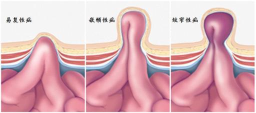 宝宝腹股沟疝什么时候手术好?选对时机,避开这个最坏的结果