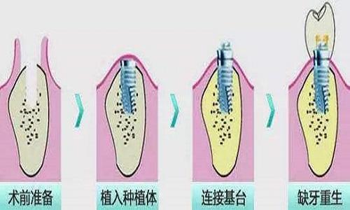 一顆完整的種植牙有種植體和基臺,牙冠組成,其中種植體材料都是金屬鈦