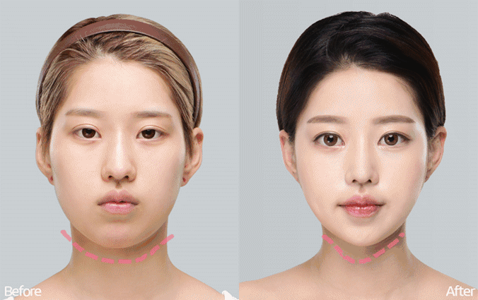 如何瘦脸简单又有效保持小v脸合照秒杀所有人