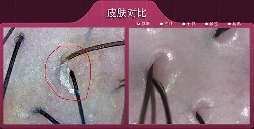 发际线移植手术前的毛囊检测,居然如此有用!