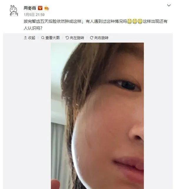 好久不见周冬雨拔智齿真的会瘦脸吗