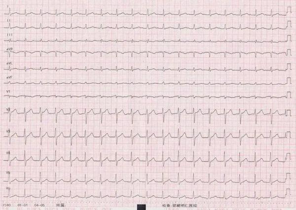 小夥反覆心悸醫生懷疑他裝病答案藏在這張心電圖裡深度解析