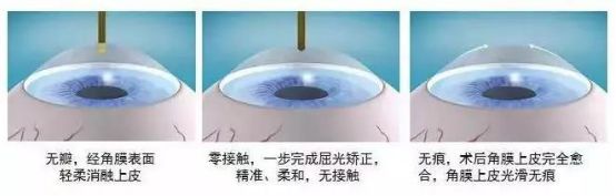 科普系列 Icl手术vs 激光手术 凤凰网