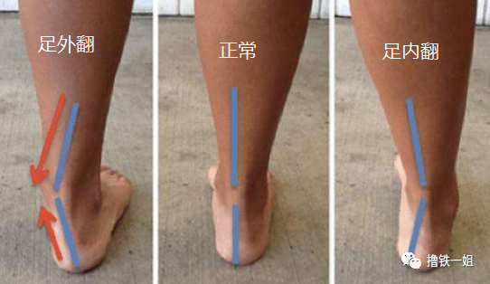一姐给大家推荐两个足外翻的改善训练.