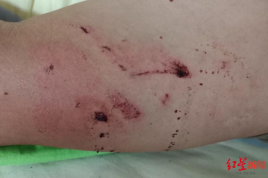 受伤的刘先生 猴子成景区"一霸" 景区已采取过诸多措施 泸山上的猕猴