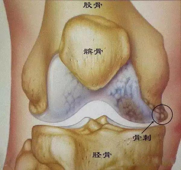 骨刺增生和骨刺是同一病吗膝盖处长了根骨刺怎么办健康百科