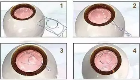 北京首大马玲珍 Icl晶体植入术适合哪些人 凤凰网