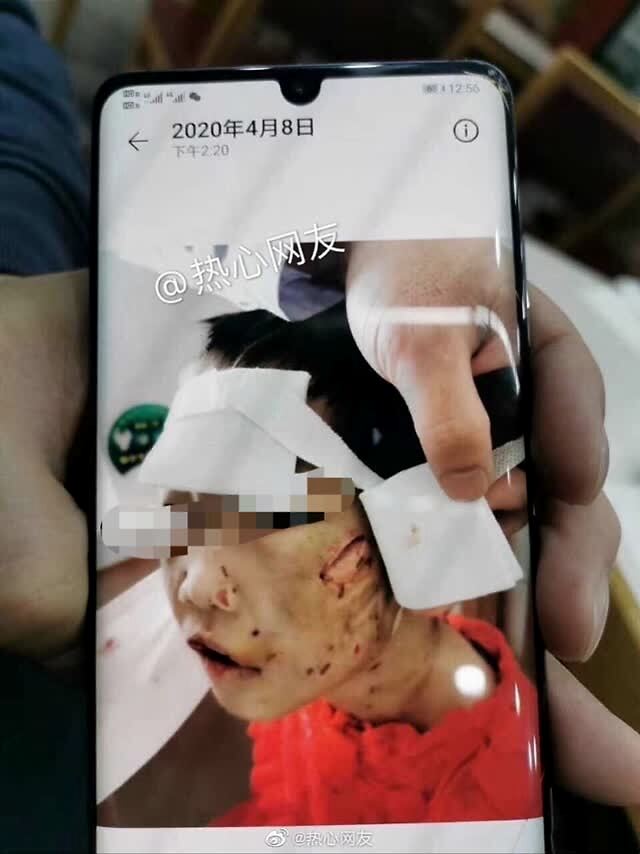 黑龙江被虐打4岁女童转送哈尔滨治疗，医院称有生命危险