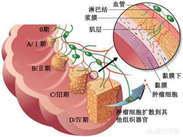 直腸癌保肛中心:直腸癌二期治癒率高不高?能活多久?