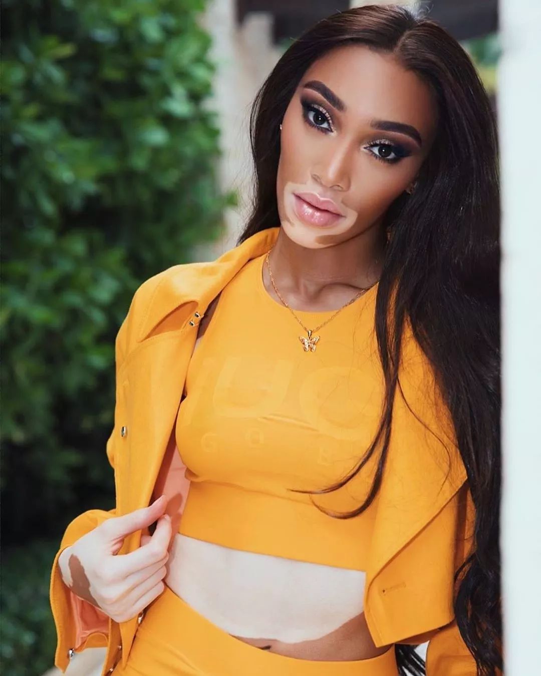 白癜风超模winnieharlow再登vogue封面slay