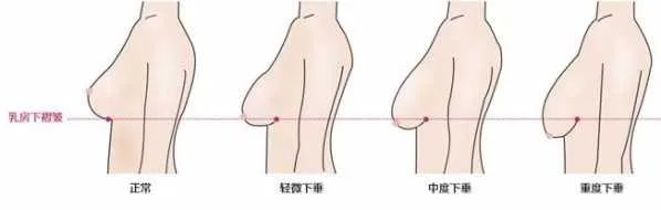 乳房以前涨奶突然软了图片