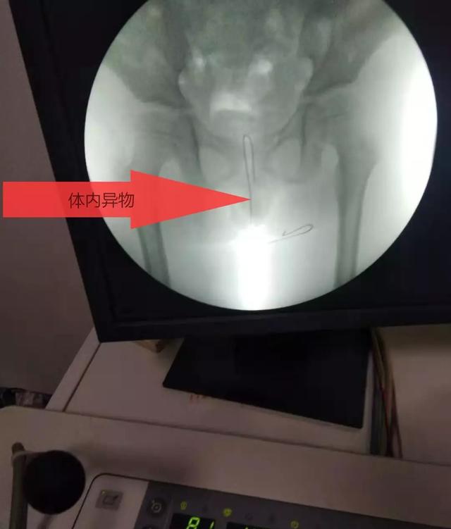 安徽含山:小男孩將一根長約20釐米鐵絲塞入肛門無法拔出