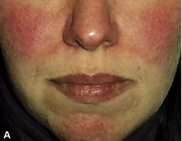 可怕的毁容式皮肤病,千万别掉以轻心__凤凰网