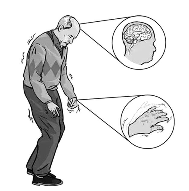 这10%帕金森病患者,竟然是父母遗传给你的