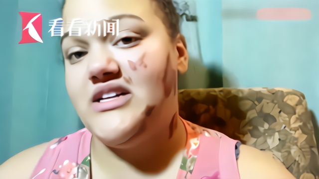 混血女生开车遭纵火 等红灯时被扔打火机脸部烧伤