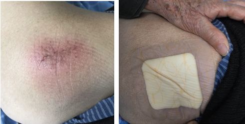 压疮敷料不可随意用,5 种实用方法 6 大注意点总结