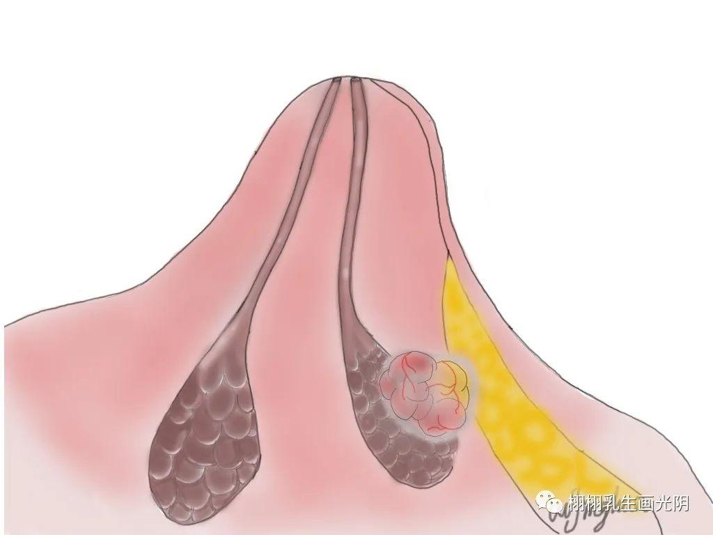 我乳房的结节会不会恶变