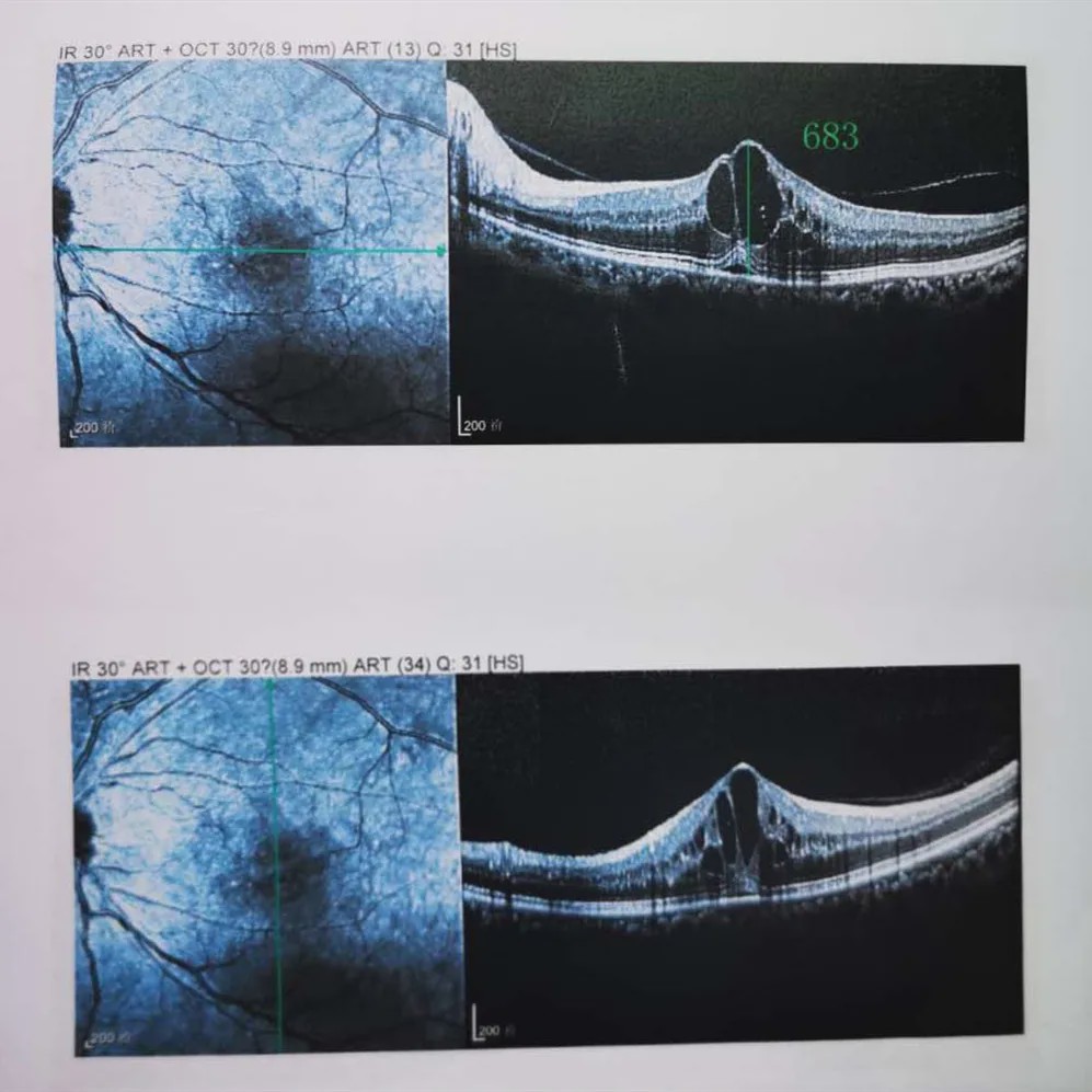 4,幸好做了这件医生强烈要求的事,治后视力回到0.