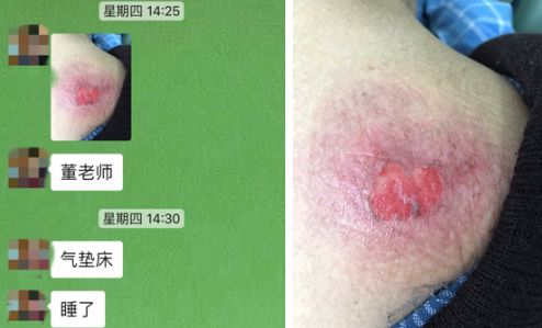 压疮敷料不可随意用,5 种实用方法 6 大注意点总结__凤凰网
