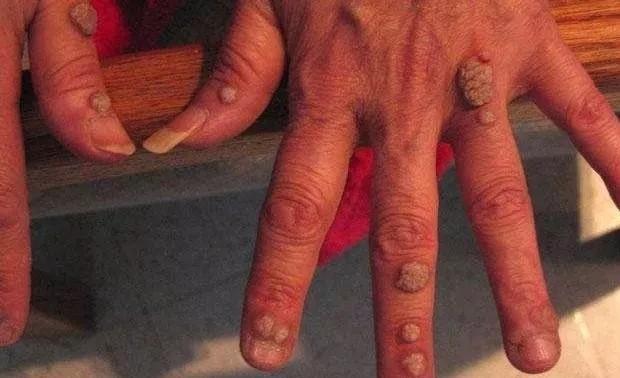 良性皮肤表现: (1)寻常疣:米粒大小的丘疹,表面角化明显,粗糙不平