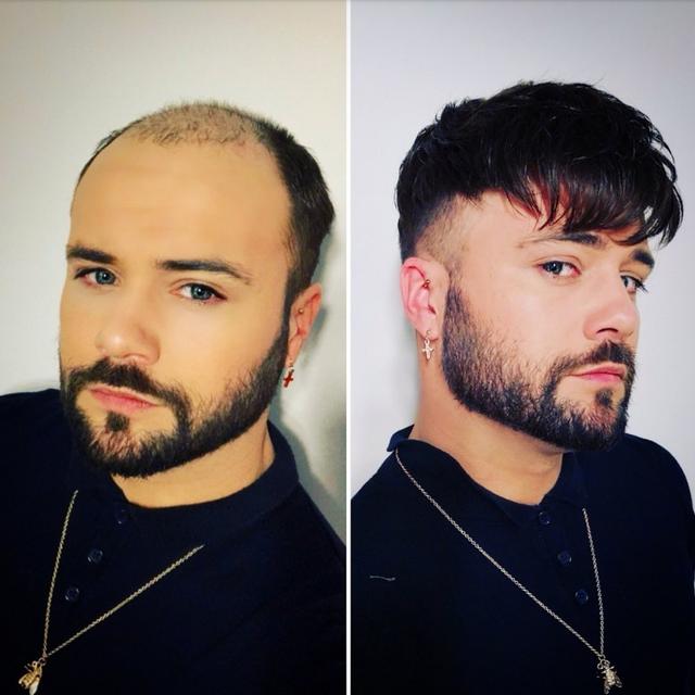 "三毛"孟智超16岁秃顶,今头发茂密帅到认不出,却赚不回植发钱