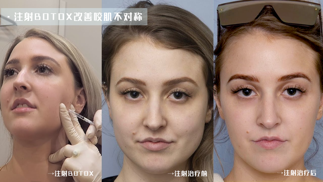 小范围的肌肉如瘦咬肌,放松颏肌等,是可以注射肉毒素来使得肌肉萎缩的
