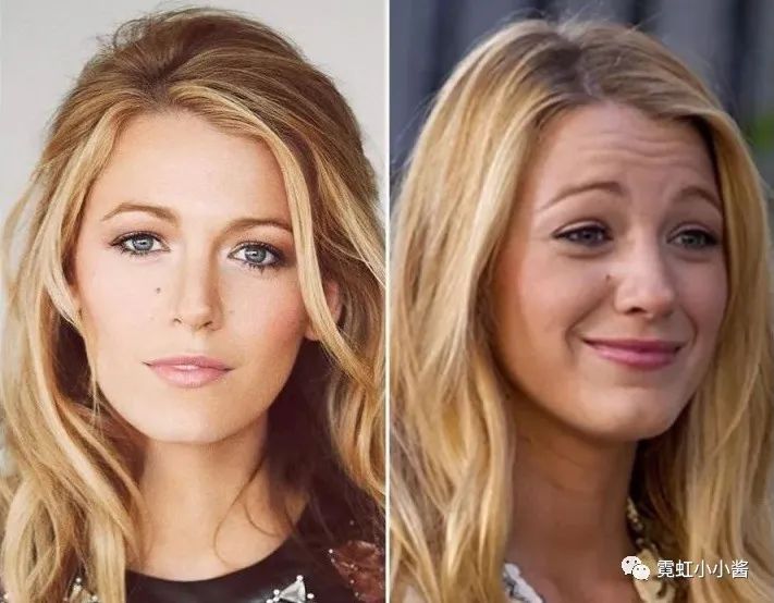 皮下内源性松弛. ▽