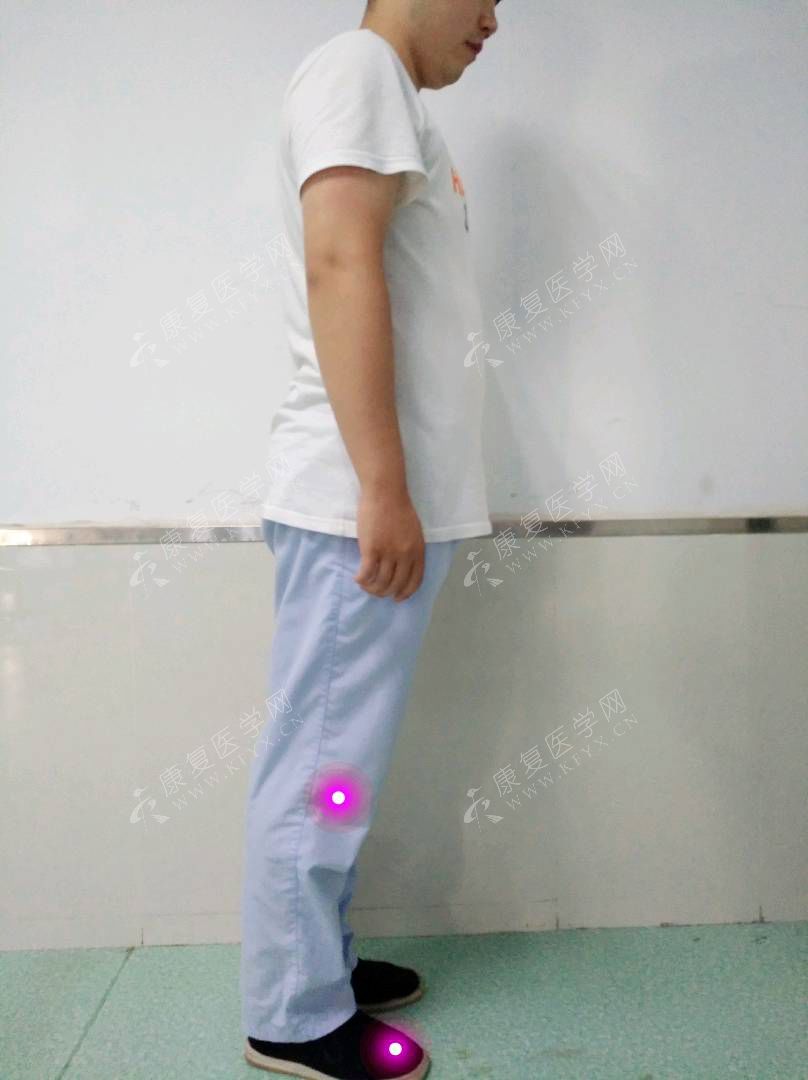 如何通过姿势评估前表线和筋膜问题？（附手法治疗）__凤凰网