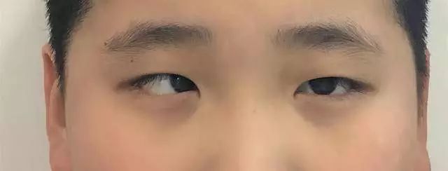 11岁孩子玩游戏玩成了斗鸡眼寒假了玩手机平板悠着点