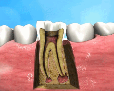 牙齿根管治疗步骤动图图片