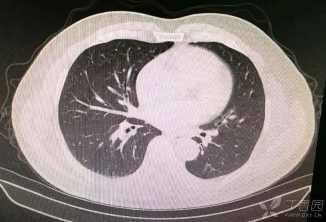 张力减低,双下肢腱反射减弱,脐平面以下针刺觉减退,双侧病理征未引出