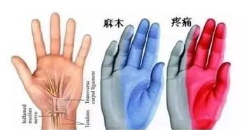 末梢神经炎疾病介绍__凤凰网