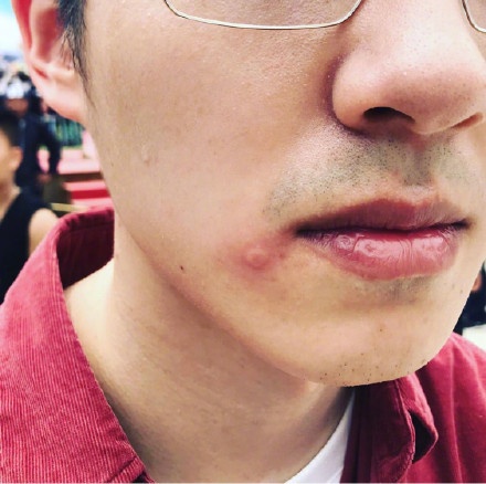 路子野?刘昊然拍戏被蜜蜂蛰,嘴边一个大包