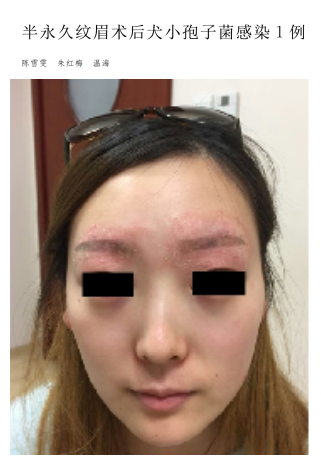 之前,在文献上看到一个病历,一个女孩子,去做半永久眉毛,结果,这皮肤