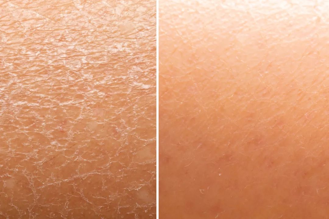 干性皮肤最好也不要使用,因为酒精的易挥发性和渗透性,会导致 皮肤