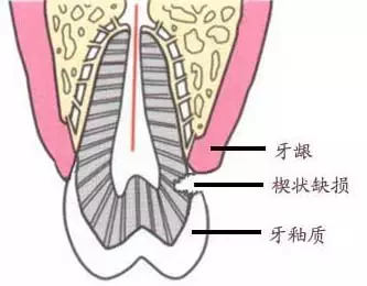 臨床上,牙齒頸部的楔形缺損分別位於上頜和下頜的切牙和磨牙.