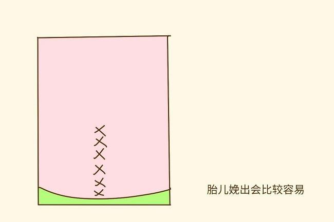 剖宫产中，横切口和竖切口有什么区别？__凤凰网