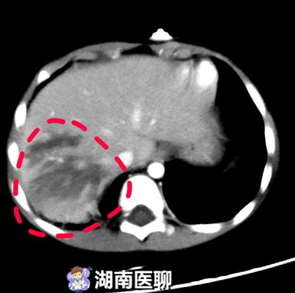 (ct结果显示肝破裂导致肝出血部位) 被送到医院的滋滋因为病情危重,又