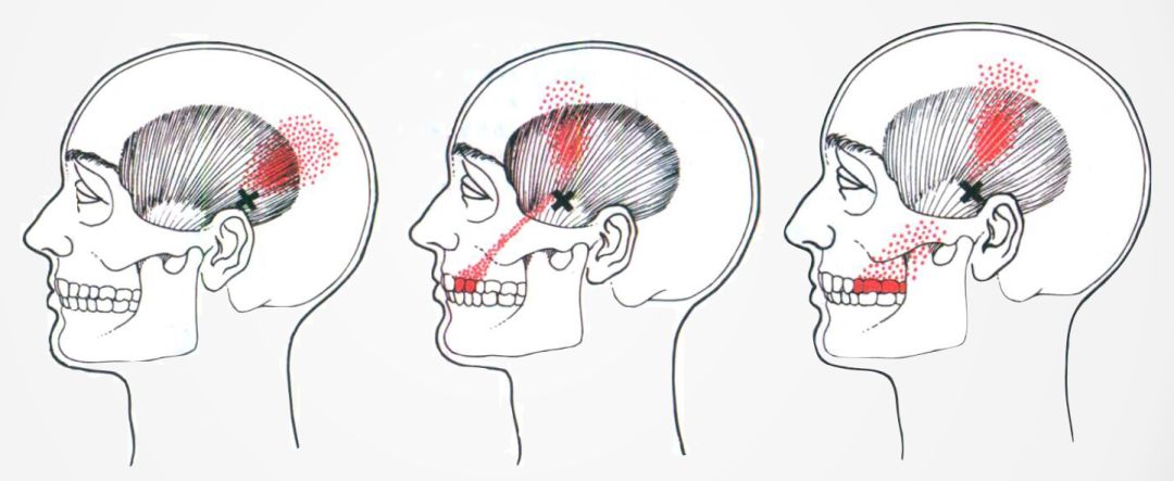 颞肌偏头痛的必松之肌