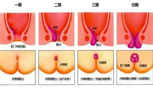 肛門掛了一坨肉:這就是傳說中的脫肛嗎?__鳳凰網