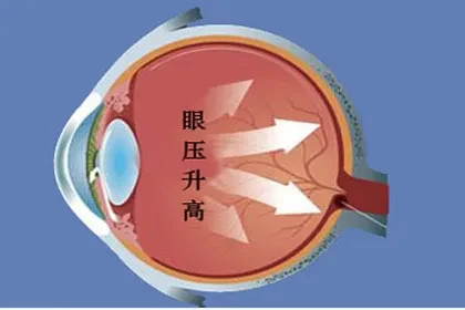 這兩類食物幫你預防青光眼趕快收藏好