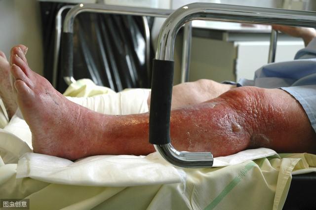 丹毒和蜂窝织炎——皮肤感染中的