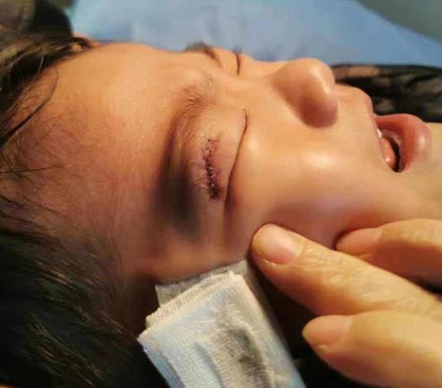 洛阳4岁娃游乐场摔破眼皮缝14针游乐场监护人有责任