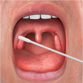 一线医护科普新冠病毒采样:咽拭子采集不规范可能造成"假阴性"